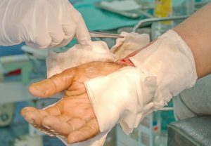 Exploring-the-Costs-of-Severe-Burn-Injuries-Beldock-and-Saunders