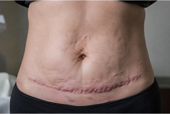 $600,000 medical malpractice settlement for disfiguring abdominal scarring